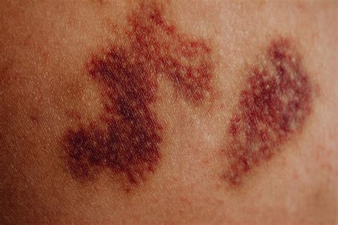 Bruising Explained How Do Bruises Form What Causes Them Science Times