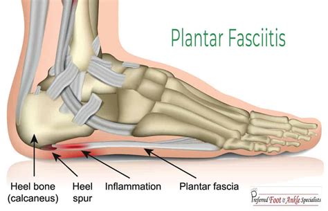 Plantar Fasciitis Treatment Heel Pain An Tâm