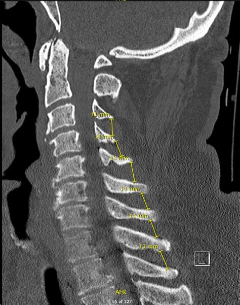Subaxial Cervical Spine Ct Clinical Tree