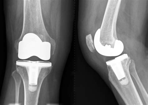 [diagram] diagram of knee replacement mydiagram online