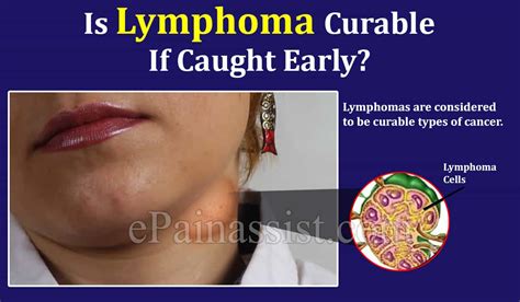 Lymphoma A Cancer Of The Lymphatic System Funeraldirect