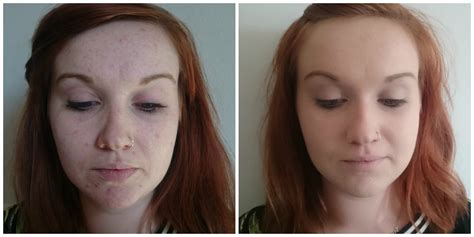Before And After Veil Cover Cream Cover Up Birthmark Vitiligo Skin