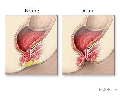 The New York Times Health Slide Show Imperforate Anus Repair