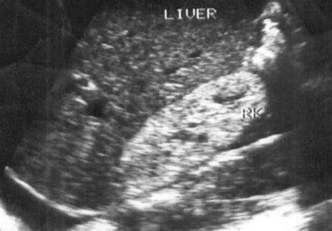 Abdominal Ultrasonography In Hivaids Patients In Southwestern Nigeria