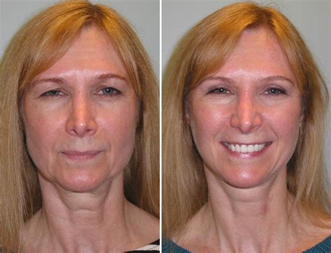 Facial Plastic Surgery Before And Afters Facial Surgery Facial