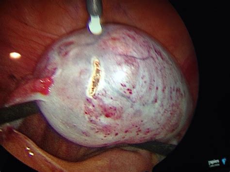 11cm Dermoid Cyst Removed From My Left Ovary In January 2017 Medicalgore