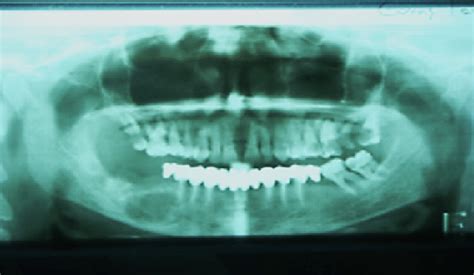 Panoramic Radiograph Evidencing The Presence Of An Osteolysis Area In