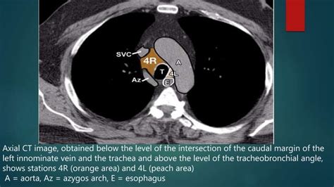 Radiological Anatomy Of Thoracic Lymph Nodes