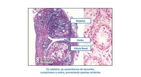 Saiba tudo sobre Hiperplasia Benigna nodular da Próstata