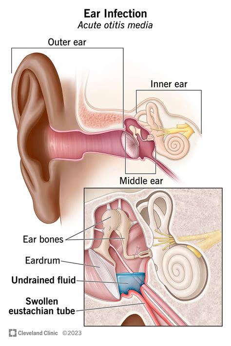 Ear Infection Otitis Media Symptoms Causes Treatment