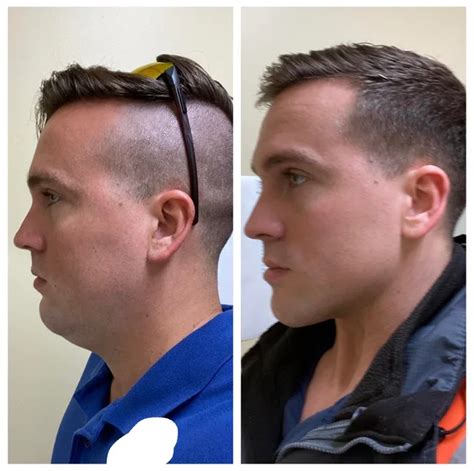Mewing Before And After 120 Amazing Progress Photos Of Adult Mens And
