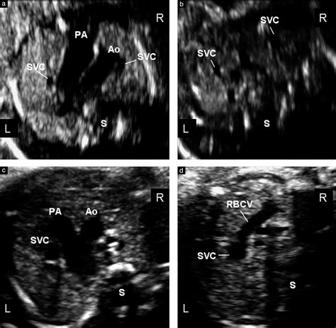 Fetal Left Brachiocephalic Vein In Normal And Abnormal Conditions