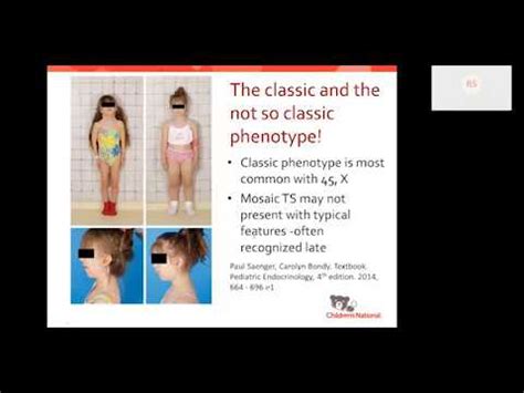 Turner Syndrome Beyond The Classic Xo Phenotype Youtube