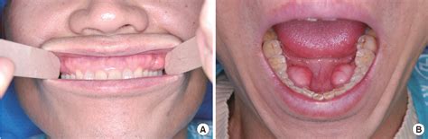 Figure 2 From Concurrence Of Torus Mandibularis With Multiple Buccal