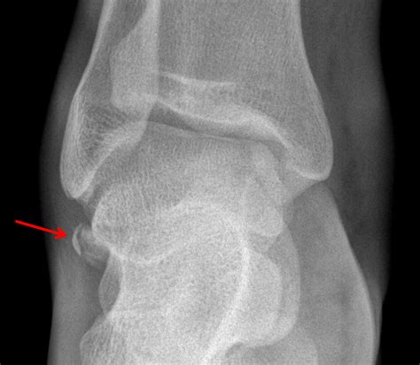Lateral Process Talus Fracture