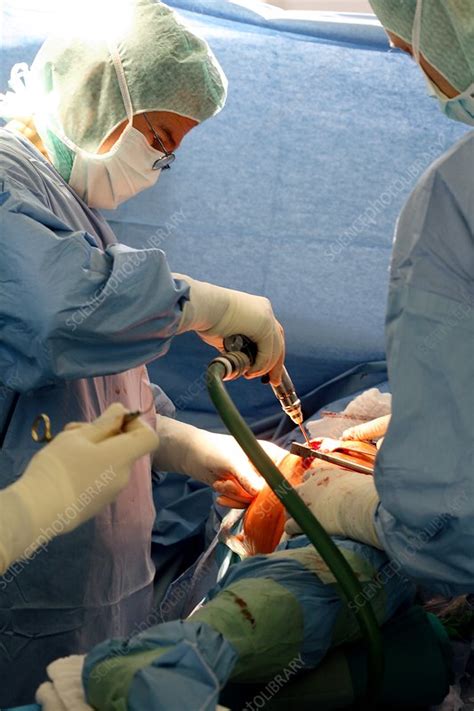 Hip Replacement Surgery Stock Image C008 7851 Science Photo Library