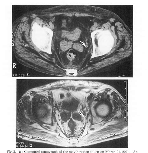 Figure 2 From Polymyositis Associated With Urinary Bladder Cancer An