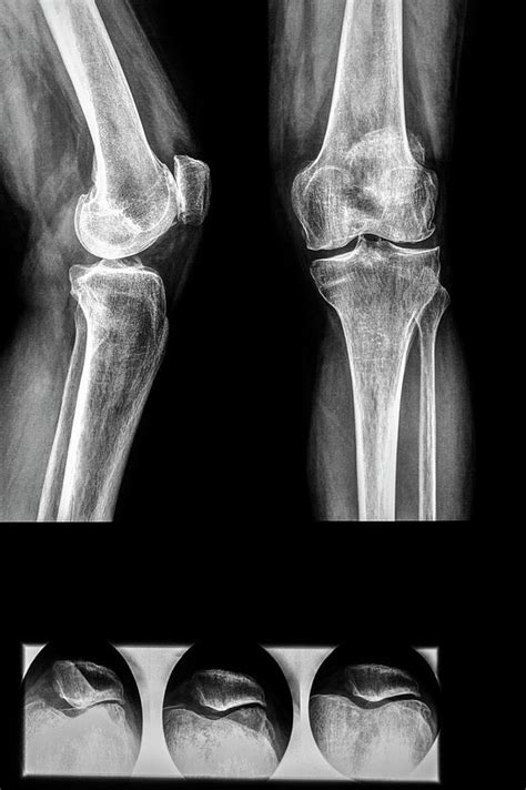 Diagnostic Knee And Knee Cap X Rays Photograph By Brian Gadsbyscience