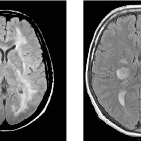 Distribution Of Mri Detected Lesions In The 20 Adult Adem Patients Mri