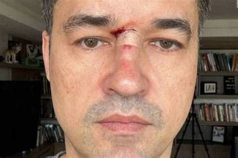 Deltan posta foto com o rosto machucado para criar mistério mas relata tombo Mais Goiás