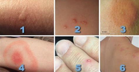 Are You Able To Recognize Different Insect Bites So You Can Treat Them