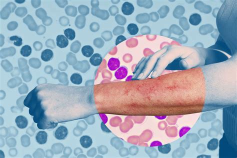Leukemia Rashes Types Causes Diagnosis And More