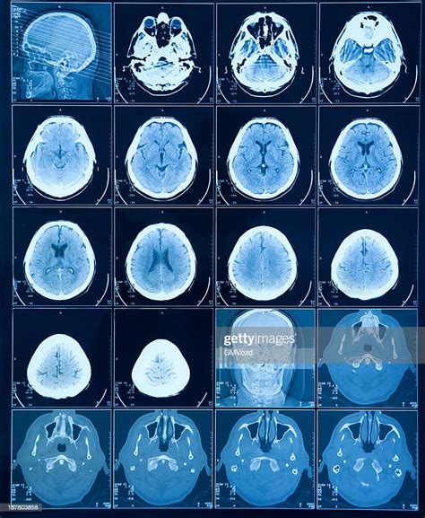 Mri Brain Scan High Res Stock Photo Getty Images