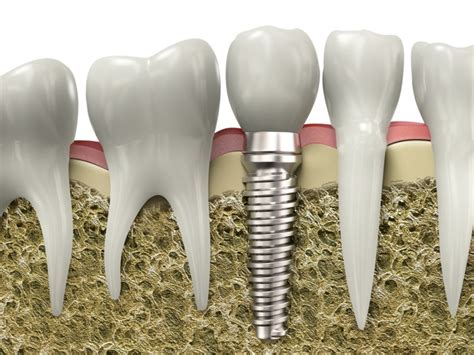 Can You Get Dental Implants In One Day