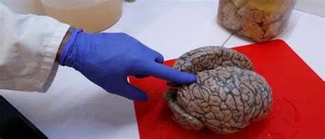 Former tackle football players with chronic traumatic encephalopathy, the degenerative brain disease linked to repeated head hits, doubled their risk scientists have known that more years playing tackle football is associated with thinking and memory deficits later in life. New Research Shows Most Football Players Had Degenerative ...