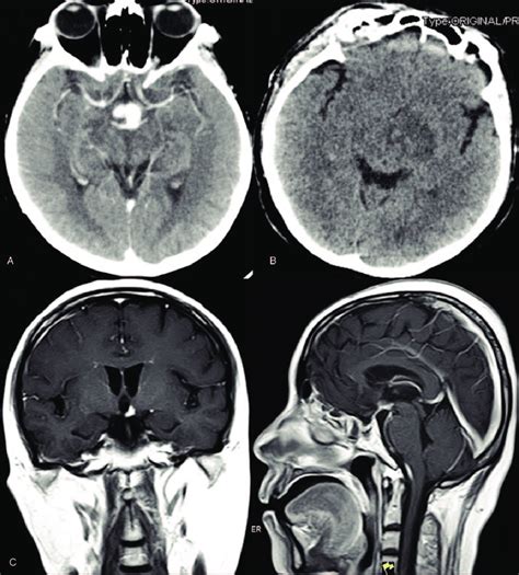 Head Ct And Mri In 2015 A Pre Operation Ct Showed Soft Tissue Density