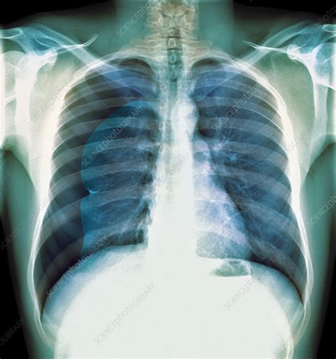 Pneumothorax X Ray Stock Image M2400663 Science Photo Library