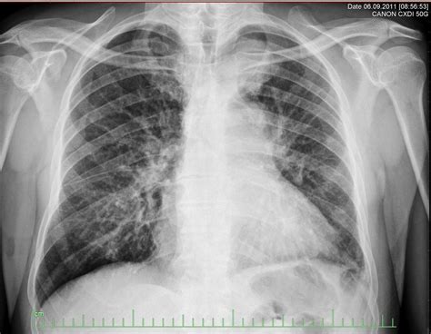 Figure 1 present some samples of normal and pneumonia lung. Lung cancer chest x ray - wikidoc
