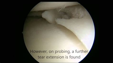 Knee Meniscal Tear Treatment Keyhole Surgery Arthroscopy Youtube