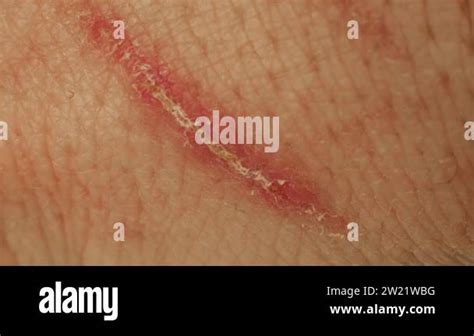Macro Of Scrape Dried Wound Closeup Healed Scratch With A Crust