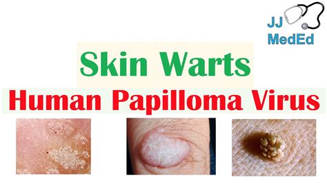 Overview Of Skin Warts Verrucae What Causes Them Who Gets Them