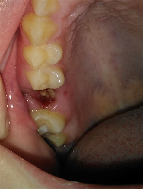 Capa Blanca En Zonas De Las Extracciones Dentales