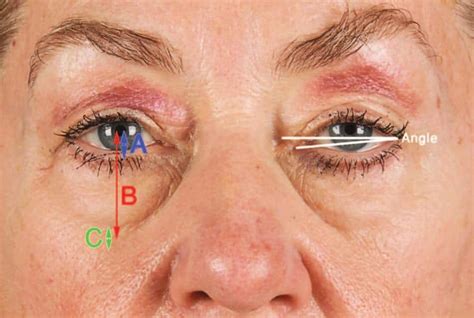 The Five Step Lower Blepharoplasty Blending The Eyelid Cheek Junction