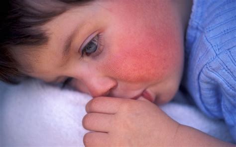 Scarlet Fever Is Back And You Need To Know The Signs