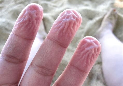 Why Fingers And Toes Get Pruney Wrinkled When Wet