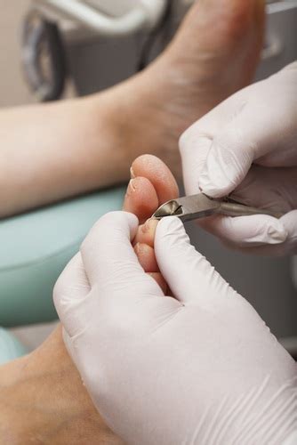 toenail cutting service kent community health nhs foundation trust