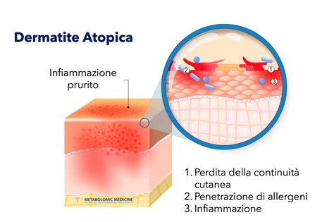 Dermatite Atopica Eczema