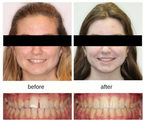 Before And After Braces Gaps