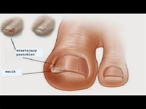 Wrastające paznokcie domowe leczenie YouTube