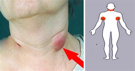 5 Swollen Lymph Nodes Home Remedies To Treat Your Condition Naturally