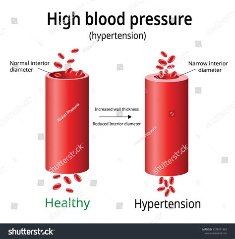 Increased Blood Pressure Images Stock Photos And Vectors Shutterstock