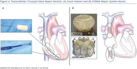 Figure 4 Transcatheter Tricuspid Valve Repair Devices A Caval
