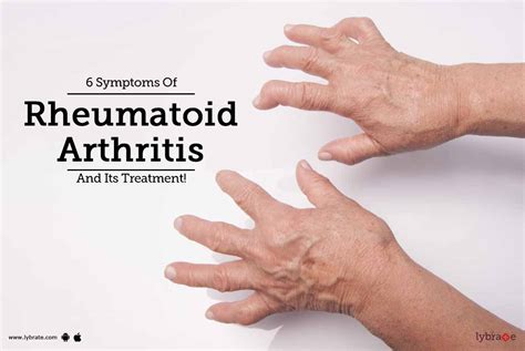 6 Symptoms Of Rheumatoid Arthritis And Its Treatment By Bansal Hospital Lybrate