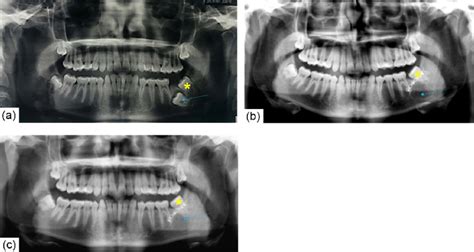 Bone Remodeling Following Buccal Lid Osteotomy Preoperative Panoramic