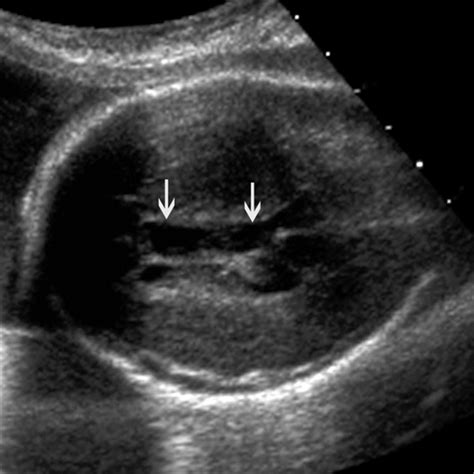 The Cavum Septi Pellucidi Winter 2010 Journal Of Ultrasound In
