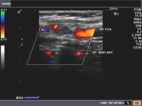 RadiologySpirit Ultrasound And Color Doppler Imaging Of Vertebral Artery